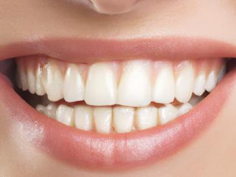 Sorriso ‘social’ perfetto e subito, è boom per le faccette sui denti anche a 14 anni